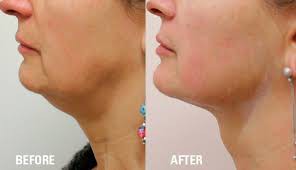 face before after  (4)