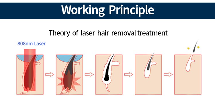 diode laser hair removal machine3