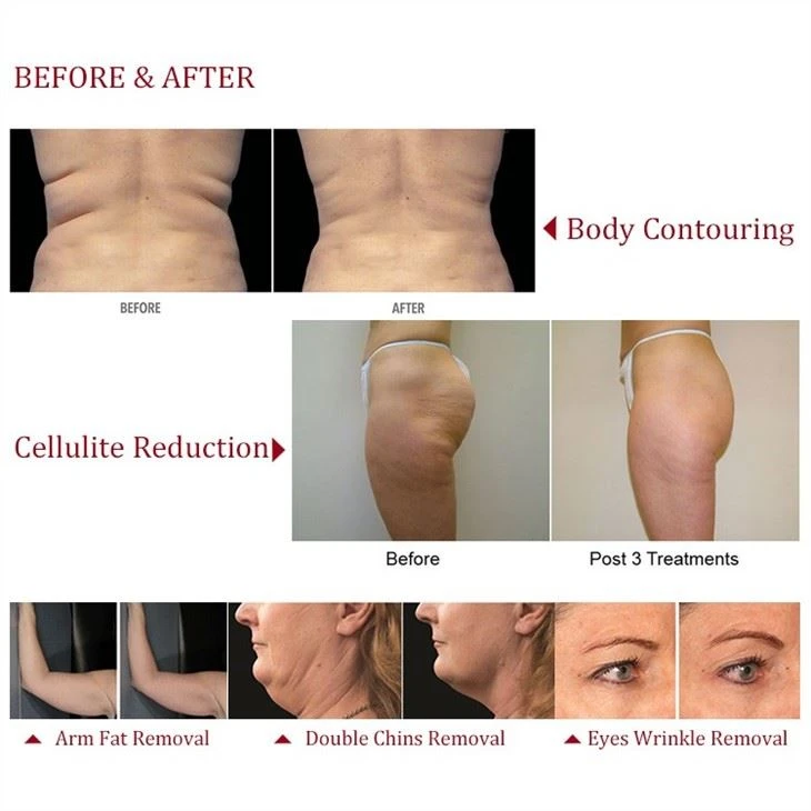 Best Body Slimming Machine